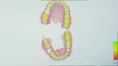 NEW YORK - 19 Şubat 2020: Diş sağlığı kliniğinde, profesyonel dişçi müşterinin ağız boşluğunu inceler. Çıkarılabilir çenenin yarısının yakın plan animasyon görüntüsü bilgisayar ekranında sahte dişler.