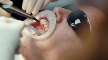 Koruyucu gözlüklü adam. Eller kapalı, dişçi diş teli takıyor. Ortodontiste resepsiyon. Cilalıyorum. Ağız cerrahisi kliniği dişleri. Yavaş çekim