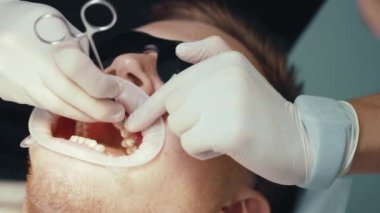 Ortodontiste resepsiyon. Özel aletleri olan eller dişçi ve asistan, diş tellerini erkek dişine takıyor. Cilalıyorum. Bakım kliniği parantezi dişleri. Yavaş çekim