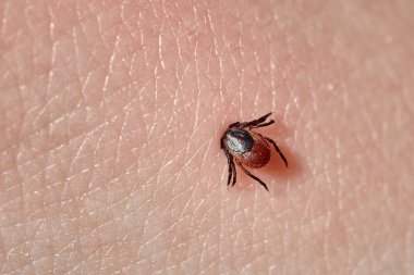 İnsan derisiüzerinde kene Makro fotoğraf emme. Ixodes ricinus. Pembe tahriş olmuş epidermis içine ısırılan şişmiş parazit
