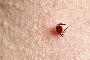 İnsan derisiüzerinde kene Makro fotoğraf emme. Ixodes ricinus. Pembe tahriş olmuş epidermis içine ısırılan şişmiş parazit