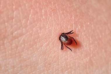 İnsan derisiüzerinde kene Makro fotoğraf emme. Ixodes ricinus. Pembe tahriş olmuş epidermis içine ısırılan şişmiş parazit