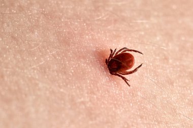 İnsan derisiüzerinde kene Makro fotoğraf emme. Ixodes ricinus. Pembe tahriş olmuş epidermis içine ısırılan şişmiş parazit