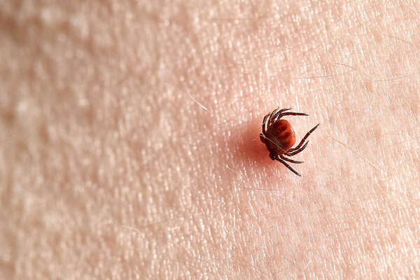 Сосание тик Макро фото на человеческой коже. Иксорицин. Раздутый паразит, укушенный в розовый раздраженный эпидермис
