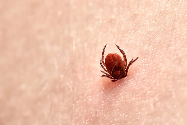 Sucking tick Macro photo on human skin. Ixodes ricinus. Bloated parasite bitten into pink irritated epidermis — Stock Photo, Image