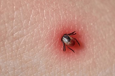 İnsan derisiüzerinde kene Makro fotoğraf emme. Ixodes ricinus. enfeksiyon tehlikesi. Biohazard
