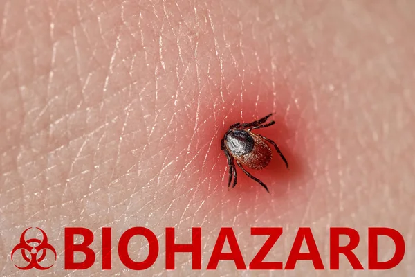 Szopogatásra kullancs makró fotó az emberi bőrön. Az Ixodes ricinus. fertőzés veszélye. Biohazard — Stock Fotó