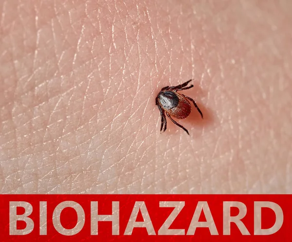 Szopogatásra kullancs makró fotó az emberi bőrön. Az Ixodes ricinus. fertőzés veszélye. Biohazard — Stock Fotó