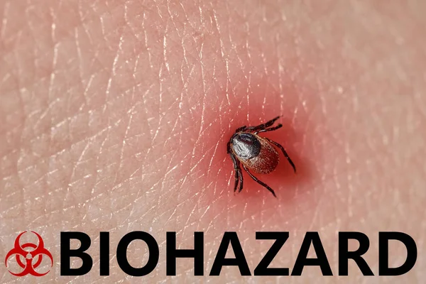 Szopogatásra kullancs makró fotó az emberi bőrön. Az Ixodes ricinus. fertőzés veszélye. Biohazard — Stock Fotó
