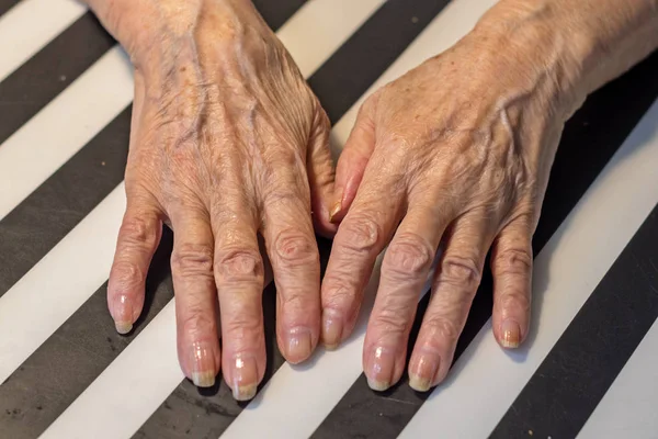 Les Mains Une Femme Âgée Reposant Sur Table Parkinson — Photo