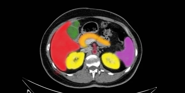 Liver, Gallbladder, Pancreas, Spleen, and Kidneys/  Annotated - Colored Computed Tomography Scan of Upper Abdomen