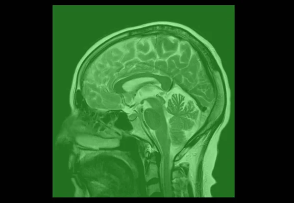 Magnetic Resonance Image (MRI) of  Normal Brain