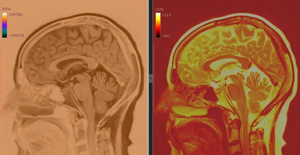Magnetic Resonance Image (MRI) of  Normal Brain