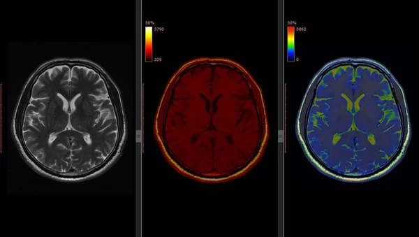 Magnetic Resonance Image (MRI) of  Normal Brain