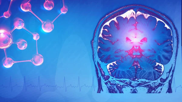 Streszczenie obrazu rezonansu magnetycznego (MRI) mózgu w — Zdjęcie stockowe