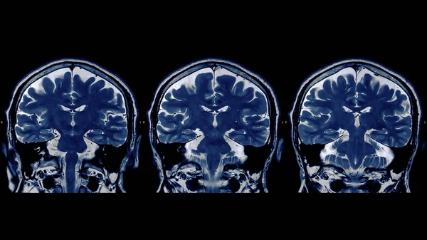 Obraz rezonansu magnetycznego (Mri) mózgu — Zdjęcie stockowe