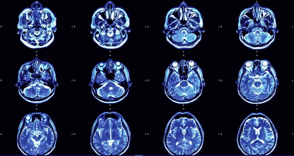 Obraz rezonansu magnetycznego (Mri) mózgu — Zdjęcie stockowe