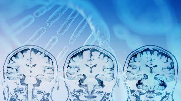 Imagem de ressonância magnética (MRI) da sobreposição cerebral com DNA str — Fotografia de Stock