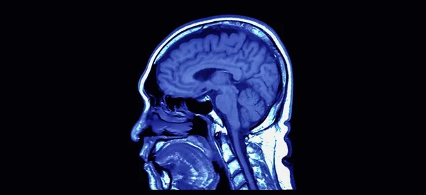 Rezonansu magnetycznego (MRI) obrazu widoku po stronie mózgu — Zdjęcie stockowe