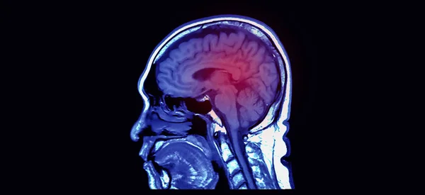 Rezonansu magnetycznego (MRI) obrazu widoku po stronie mózgu — Zdjęcie stockowe