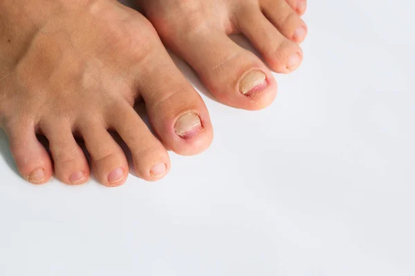 Deformed Nails Legs White Background — Stock Photo, Image