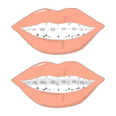 Download Smile With Braces Free Vector Eps Cdr Ai Svg Vector Illustration Graphic Art