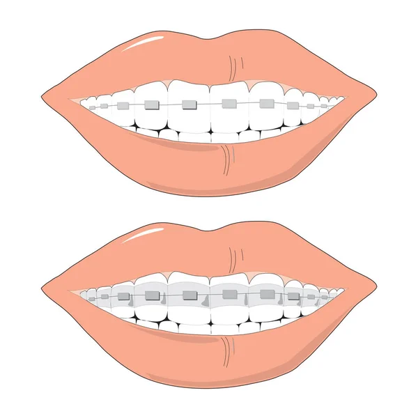 Zuby s rovnátky nějak krásná žena úsměv izolované na bílém vektorové ilustrace — Stockový vektor