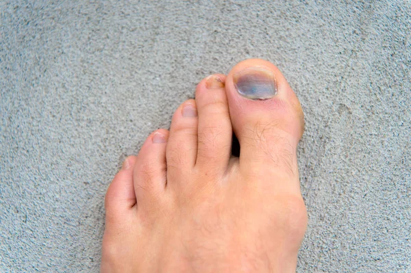 Injury of toe nail. Effects wearing uncomfortable footwear. Nail hematoma. Take care of your feet. Pedicure and podiatry. Treatment of bruise and fracture. Medicine concept. Trauma foot toes nails