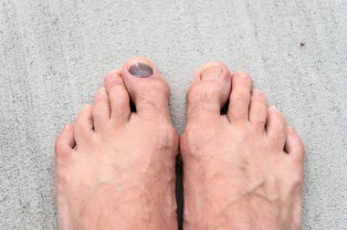 Ayaklarına iyi bak. Pedikür ve podiatri. Çürük ve kırık tedavisi. Tıp kavramı. Travma ayak tırnakları. Ayak tırnağının yaralanması. Rahatsız ayakkabı giyen etkileri. Tırnak hematom