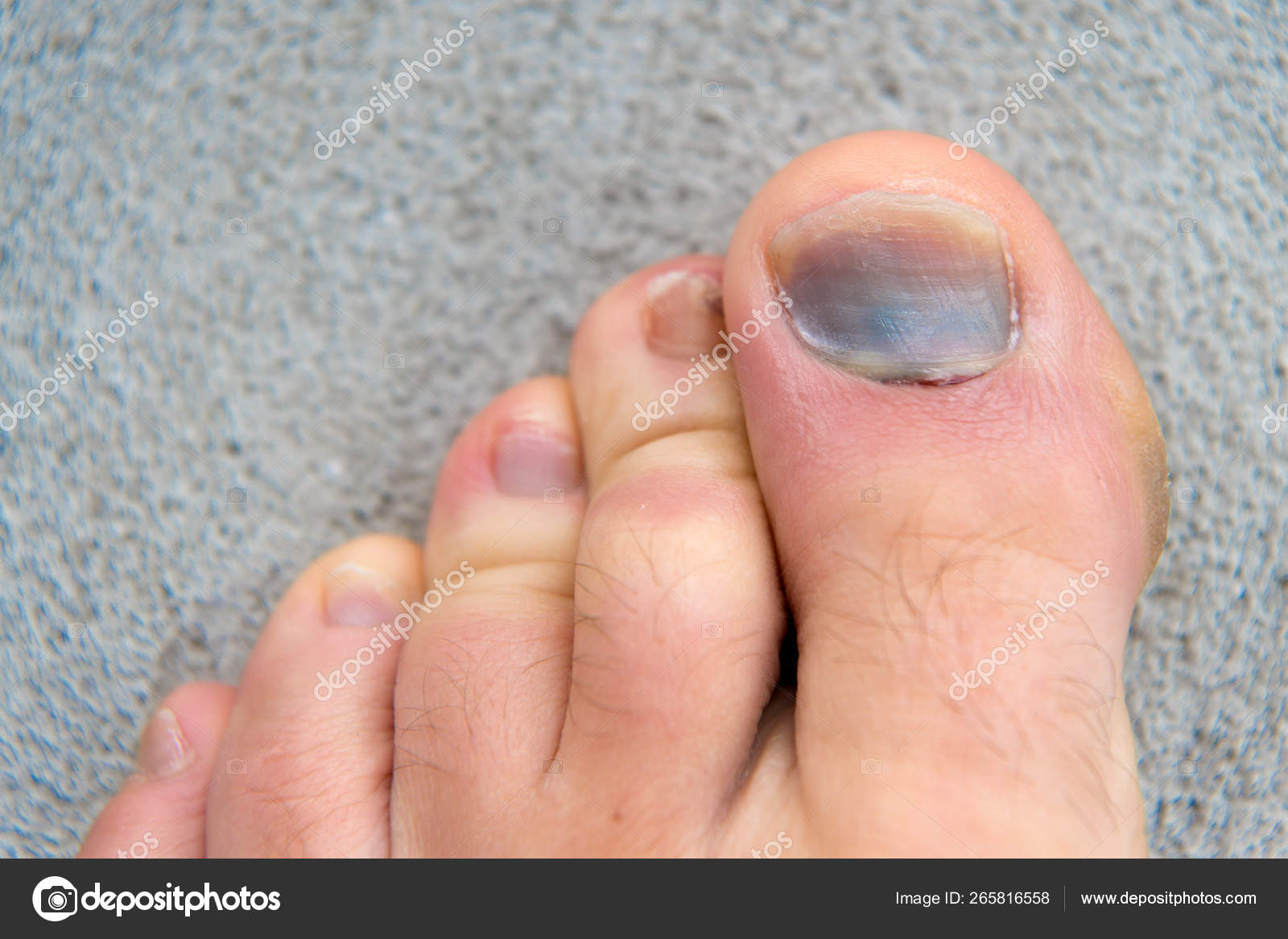 Toe injury. bruise and trauma treatment. medical intervention. fracture