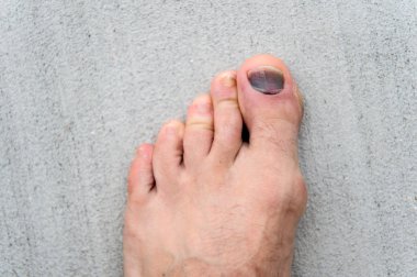 Tırnak hematom. Ayaklarına iyi bak. Pedikür ve podiatri. Çürük ve kırık tedavisi. Tıp kavramı. Travma ayak tırnakları. Ayak tırnağının yaralanması. Rahatsız ayakkabı giyen etkileri