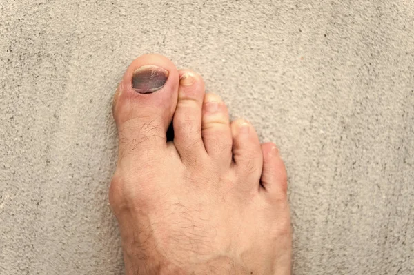 Nail hematoma. Take care of your feet. Pedicure and podiatry. Treatment of bruise and fracture. Medicine concept. Trauma foot toes nails. Injury of toe nail. Effects wearing uncomfortable footwear
