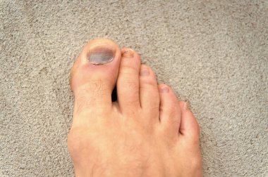 Ayak tırnağının yaralanması. Rahatsız ayakkabı giyen etkileri. Tırnak hematom. Ayaklarına iyi bak. Pedikür ve podiatri. Çürük ve kırık tedavisi. Tıp kavramı. Travma ayak tırnakları