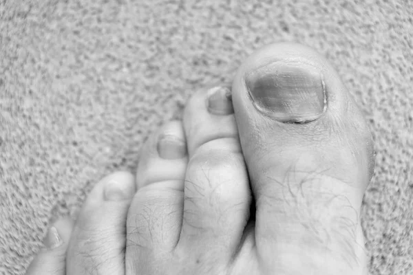 Lesione ai piedi. trattamento di lividi e traumi. intervento medico. frattura. scarpe scomode. fungo delle unghie. Piedi sani. malattia dell'ematoma del dito. Podologia della pedicure. Trattamento dei lividi e delle fratture — Foto Stock