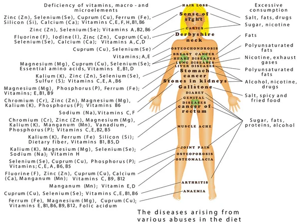 Abus Régime Les Maladies Découlant Divers Abus Dans Régime Alimentaire — Image vectorielle