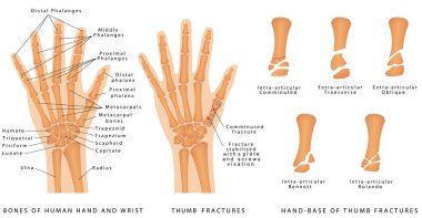 Başparmak kırıkları. İnsan eli anatomiyi kemirir. El-başparmak kırıklarının tabanı. Yerinden oynamış çatlaklar ve yerinden çıkmamış çatlaklar. Çeşitli çatlakları tedavi etmek için kablo, plaka ve vida kullanımı