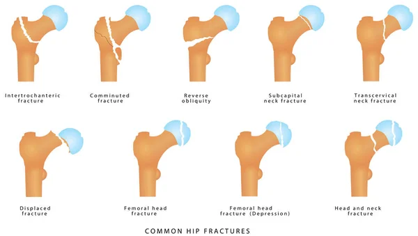 Fracturas Cadera Fracturas Del Fémur Proximal Tipos Fractura Del Cuello — Archivo Imágenes Vectoriales