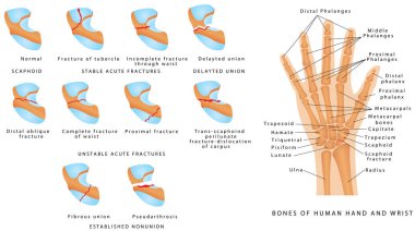 Wrist fracture (Scaphoid). Classification of scaphoid fractures. Break of the scaphoid bone in the wrist. Scaphoid bone fracture medical vector illustration on white background clipart