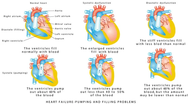 心力衰竭心力衰竭 抽吸和充盈问题 室性功能障碍 舒张性功能障碍 心力衰竭或充血性心力衰竭 心脏疾病 — 图库矢量图片