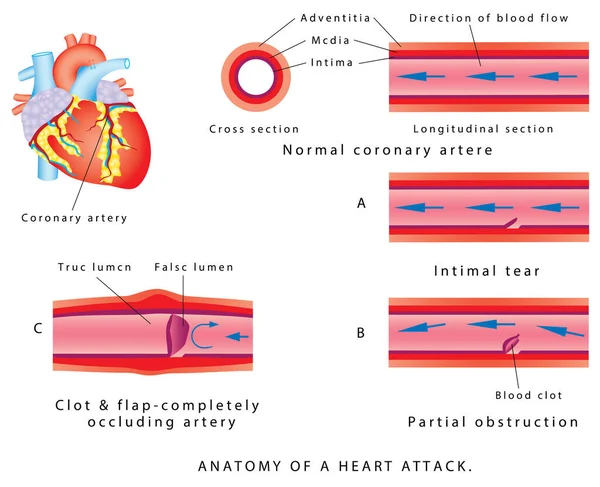 Ataque Cardíaco Anatomía Ataque Corazón Ataque Cardíaco Aterosclerosis Sección Vasos — Vector de stock