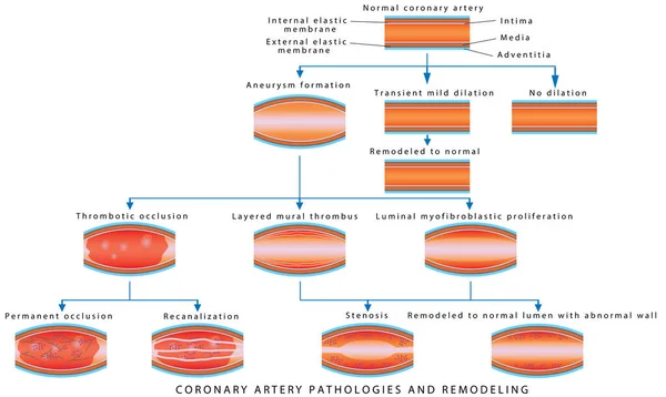 Patologie Věnčitých Tepen Arteriální Remodelace Lékařská Ilustrace Patologií Věnčitých Tepen — Stockový vektor