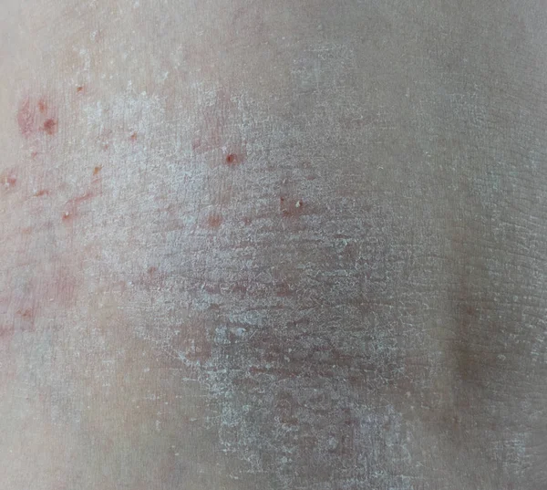 12 yaşındaki bir gençte atopik dermatit, diz altında bacaklarda kuruluk ve diğer belirtilerle kendini gösterir.