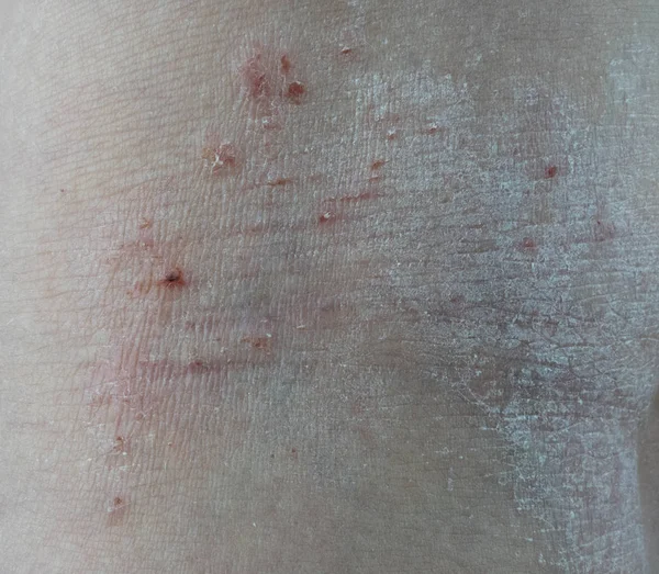 12 yaşındaki bir gençte atopik dermatit, diz altında bacaklarda kuruluk ve diğer belirtilerle kendini gösterir.