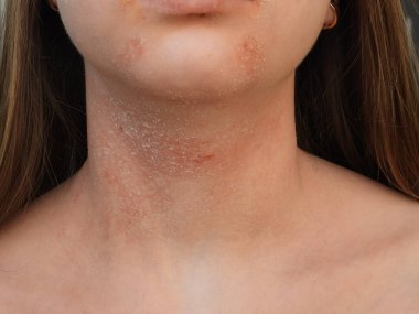Boynun ön yüzeyindeki kızarıklığın sertleşme evresinde atopik dermatit.