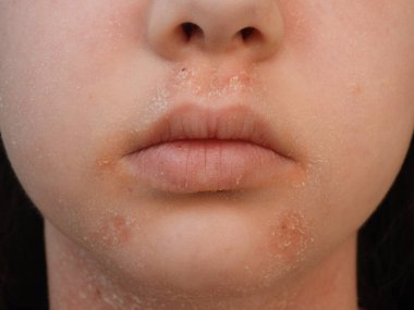 Dudak bölgesinde kızarıklığı soyan sertleşme evresinde atopik dermatit.