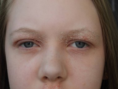 Atopik dermatit göz bölgesindeki kızarıklığın şiddetlenmesi aşamasında.