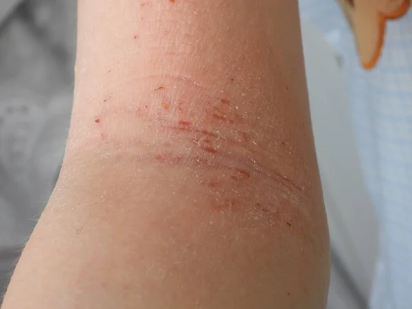 上臂干性皮肤充血裂隙上的非典型皮肤炎牛皮癣 — 图库照片