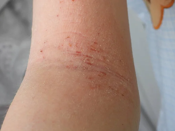 Koldaki atopik dermatit sedef hastalığı kuru cilt hiperemisi çatlakları.