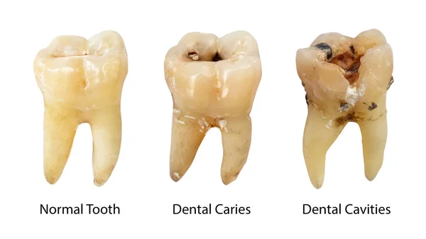 Dente Normal Cárie Dentária Cavidade Dentária Com Cálculo Comparação Entre — Fotografia de Stock