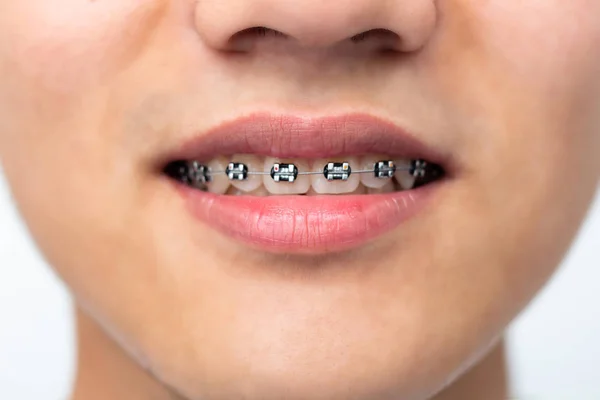 Olhar Está Perto Aparelho Dos Dentes Nos Dentes Brancos Menino — Fotografia de Stock